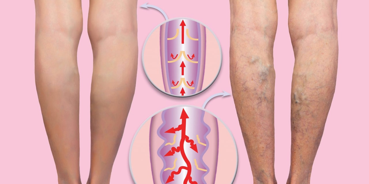 Варикоз Вен На Ногах В Спорте