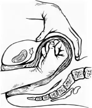 Массаж матки после родов. Бимануальный массаж матки. Бимануальное исследование матки. Бимануальная компрессия матки после родов. Ручное исследование послеродовой матки.